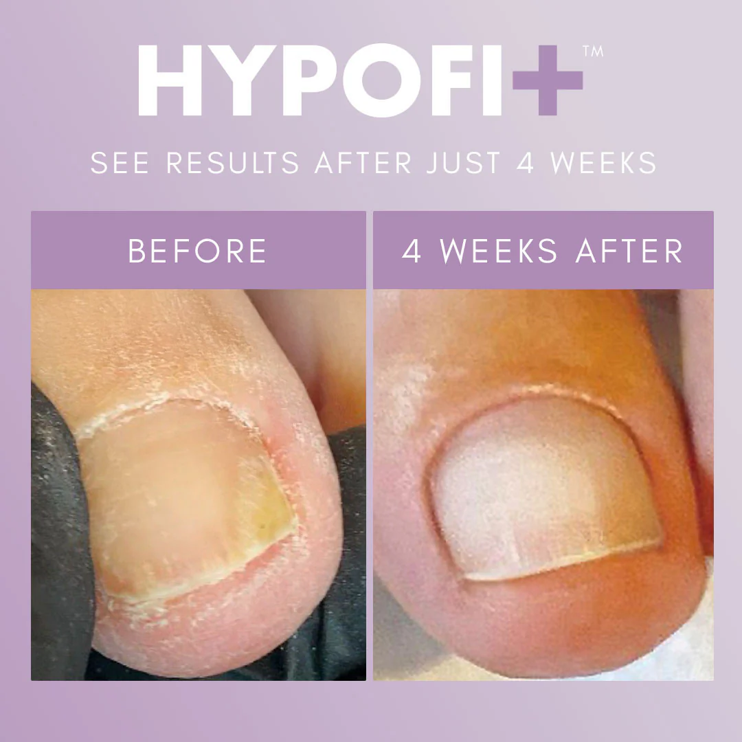 The GelBottle - HypoFix 2-Step System - Image 2